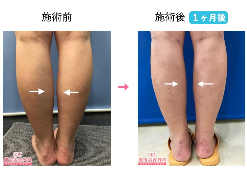 華奢な膝下を手に入れて、今年はロングブーツも履きこなす♪