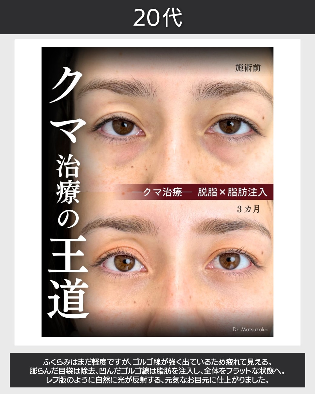 20代 - 光を反射する