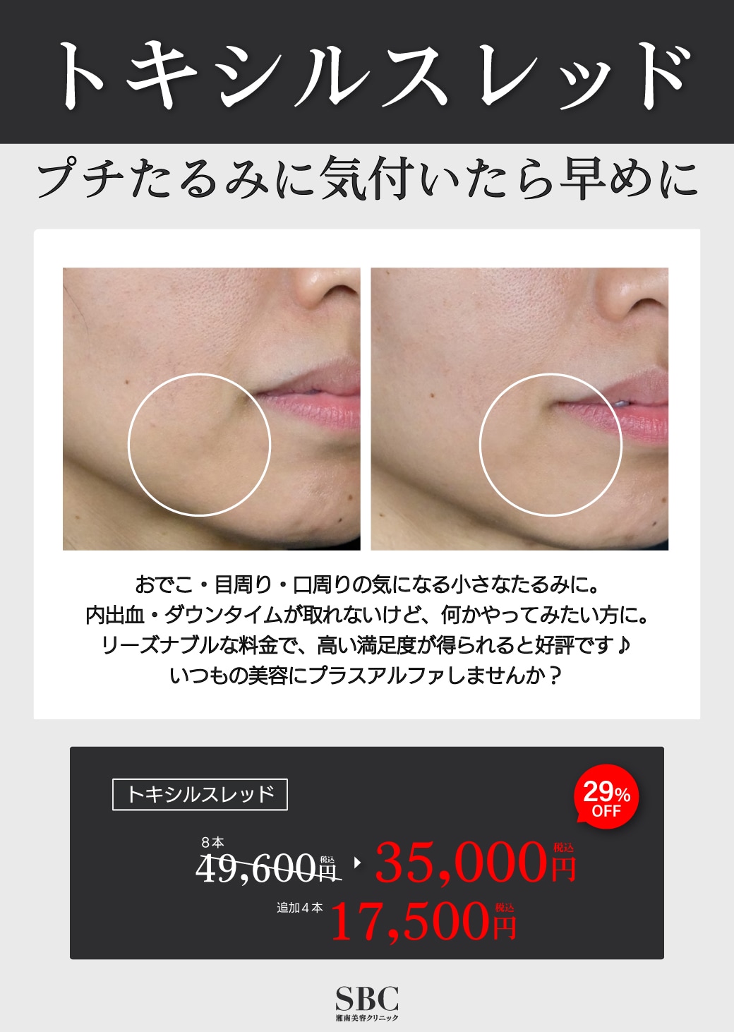 SBCトキシルスレッド