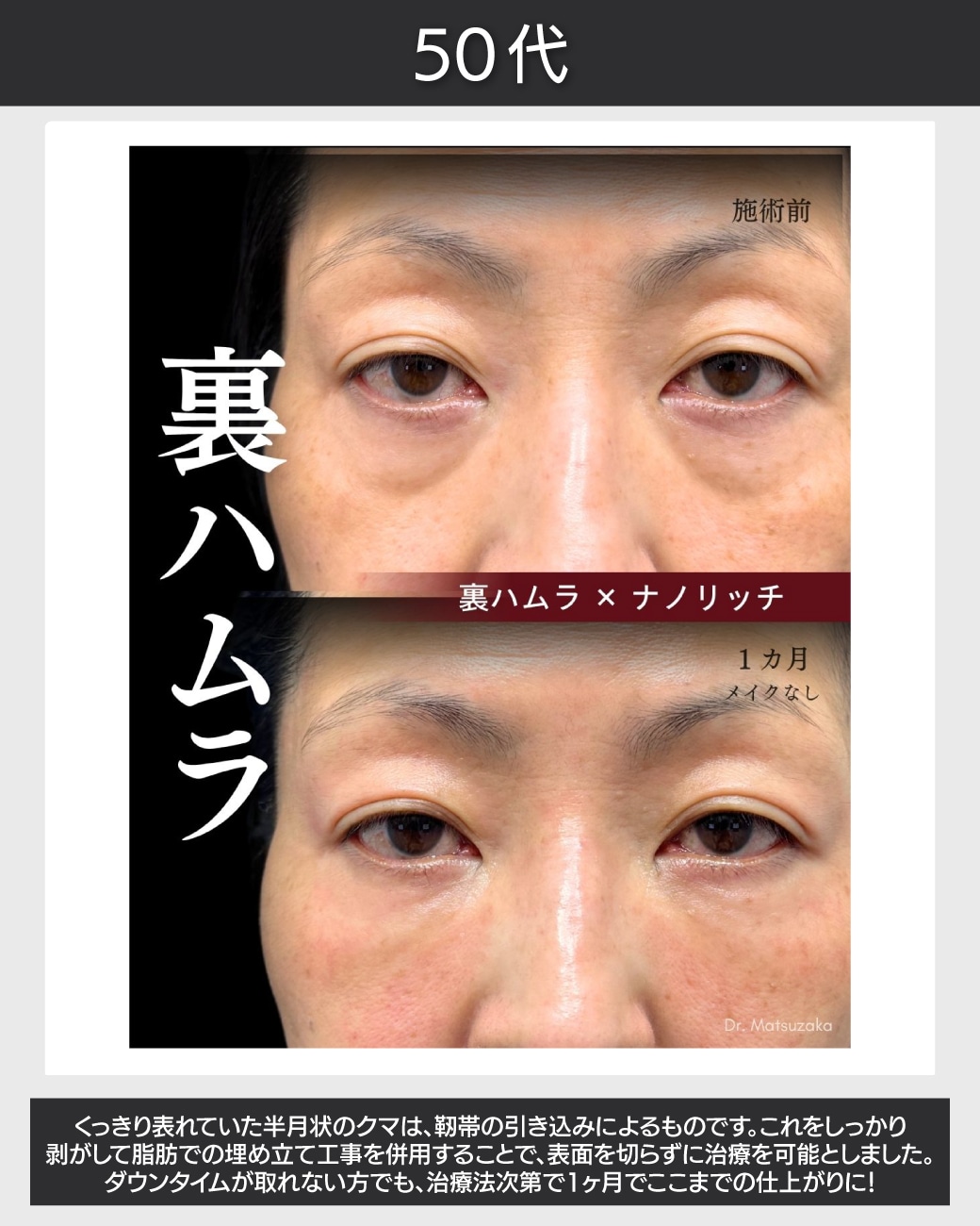 50代 - 長年酷使して緩んでしまった