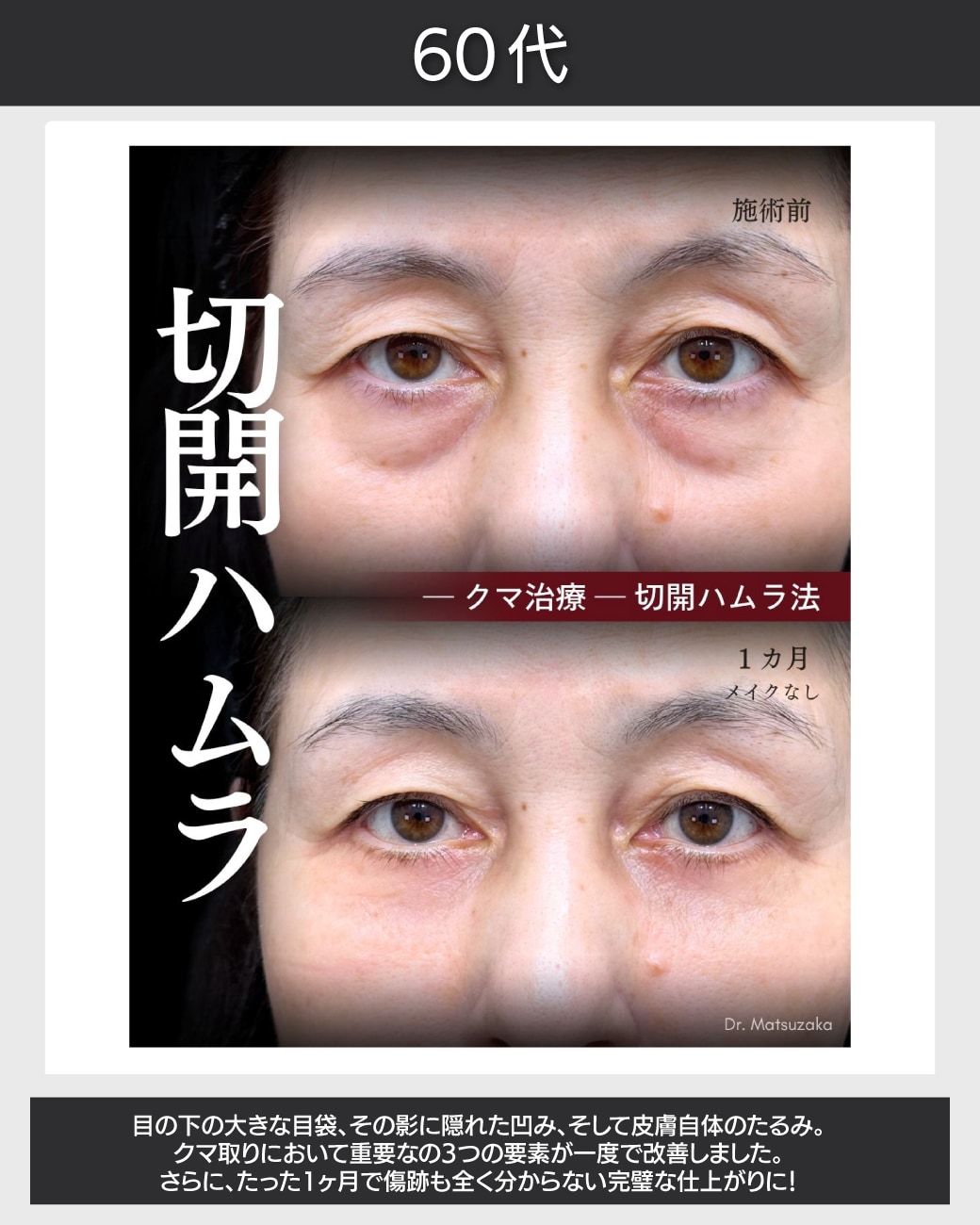 60代 - 切るクマ取りなら伸びきった皮膚も