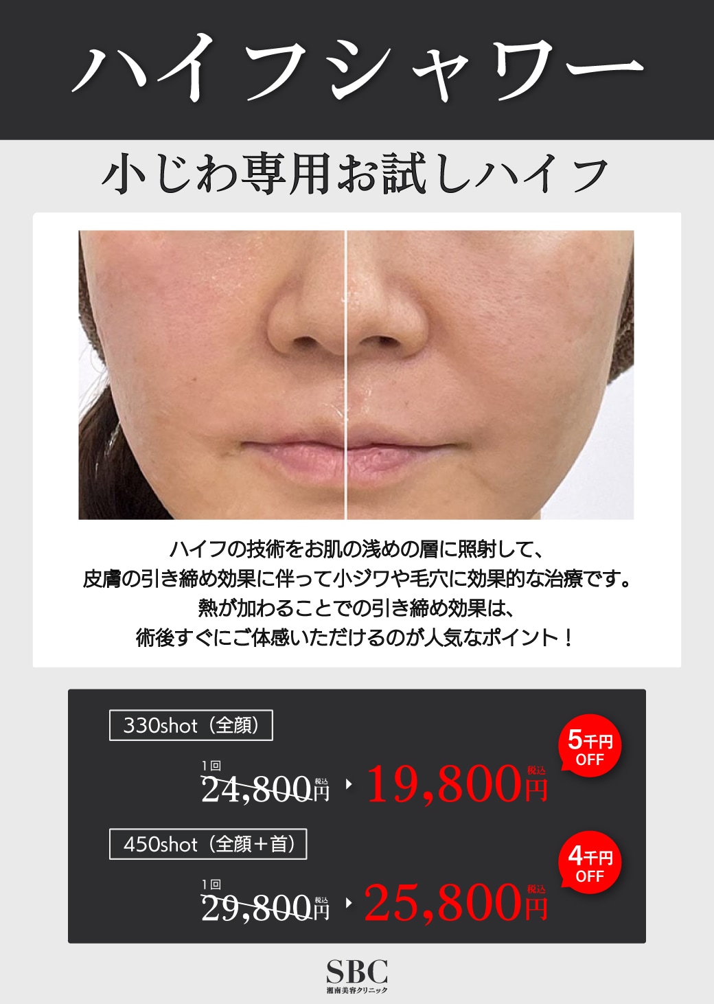 SBCハイフシャワー