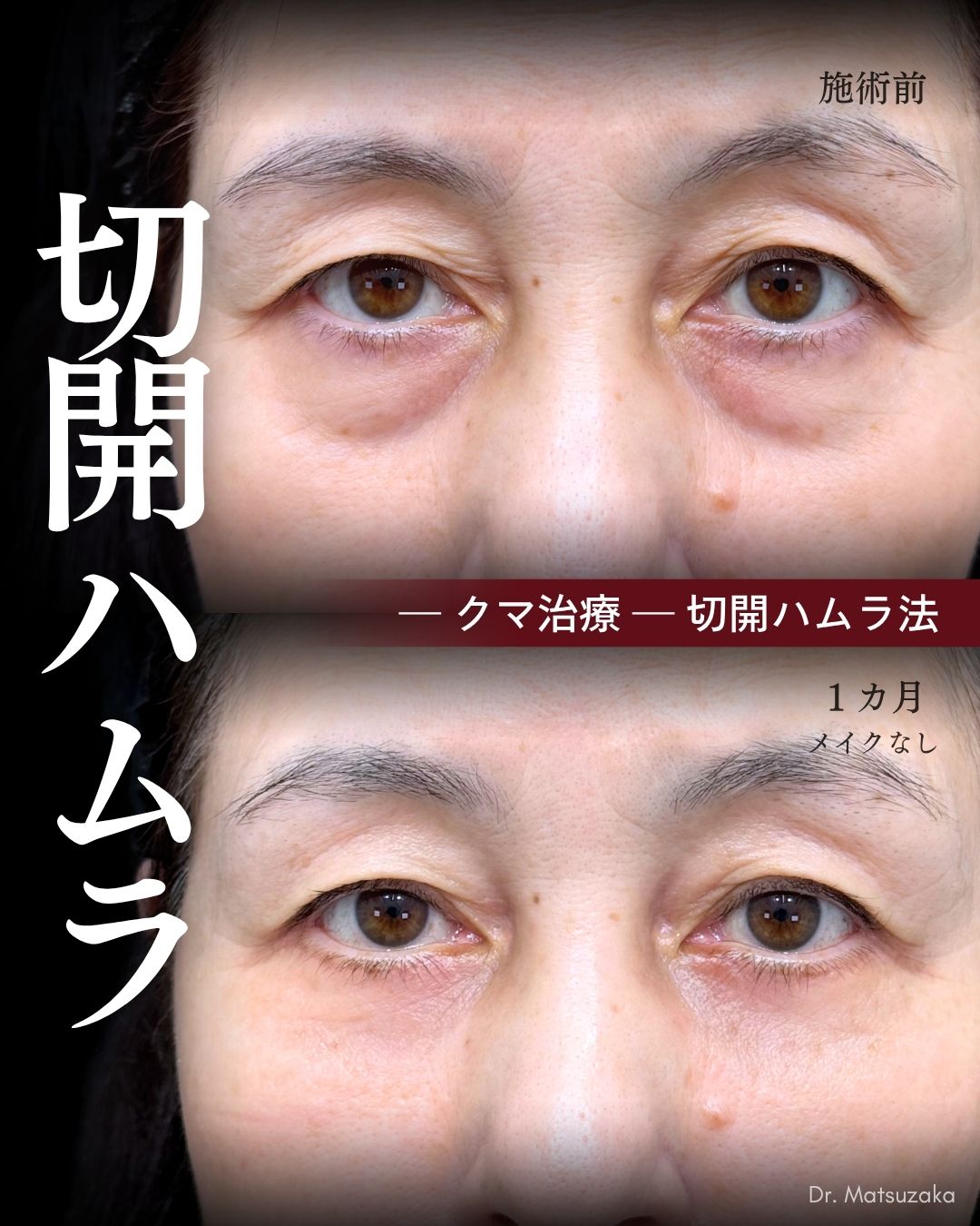 60代 - 切るクマ取りなら伸びきった皮膚も