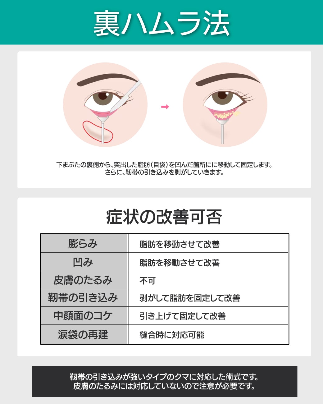【靭帯剥がし】裏ハムラ法