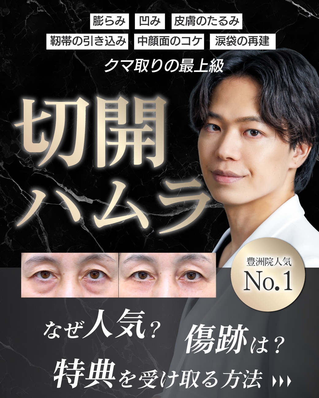 【切開ハムラ】SBC最優秀ドクター松阪医師なら傷跡なし!皮膚のたるみ・中顔面のリフトアップ・涙袋など『全ての悩みが解決』できるクマ取り