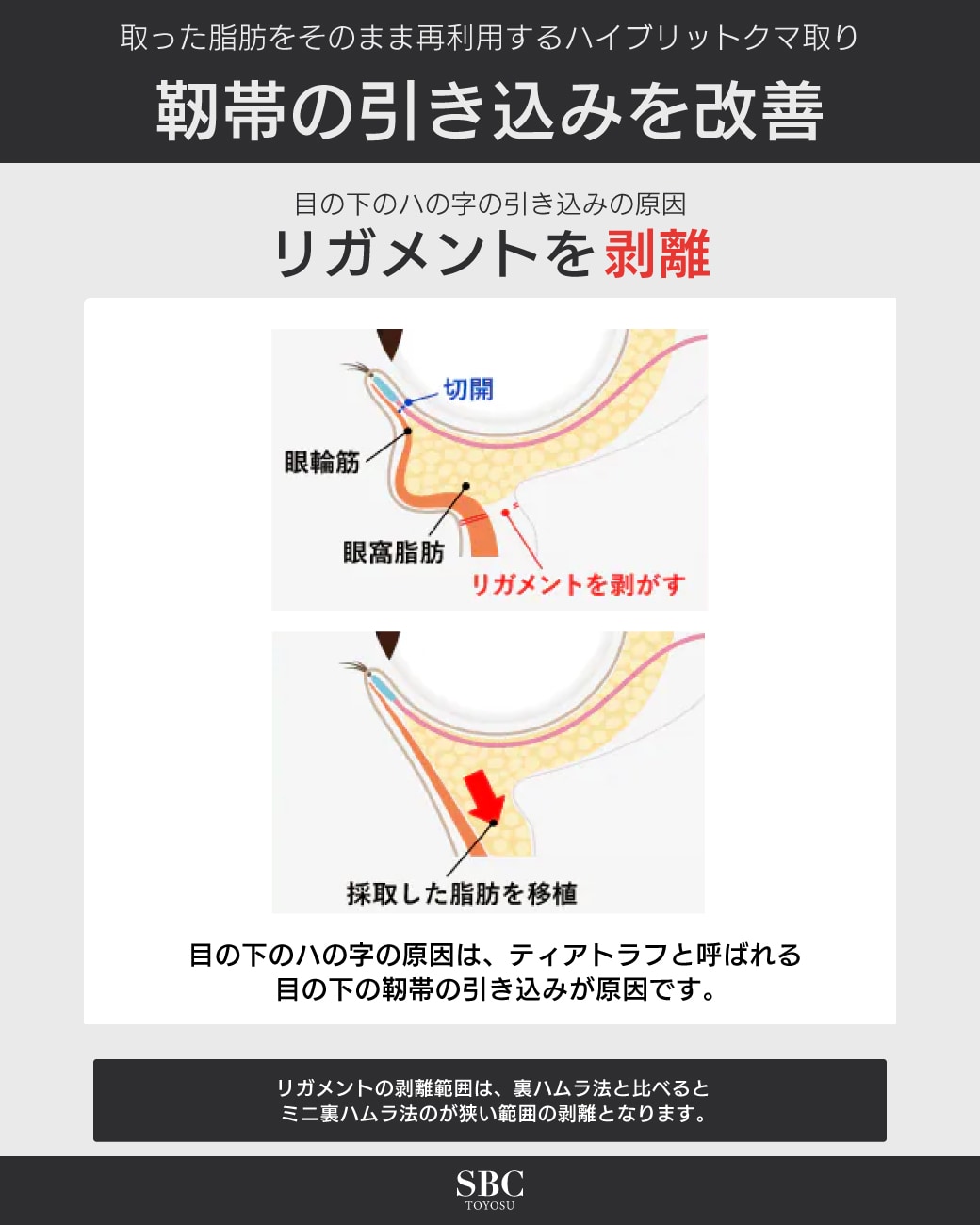 リガメントを剥離