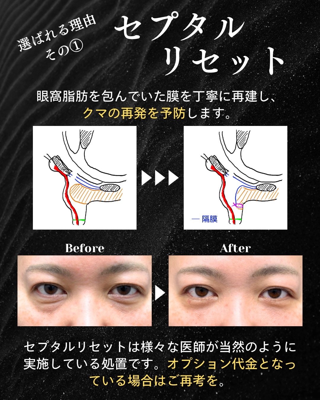 クマの再発を予防する「セプタルリセット」