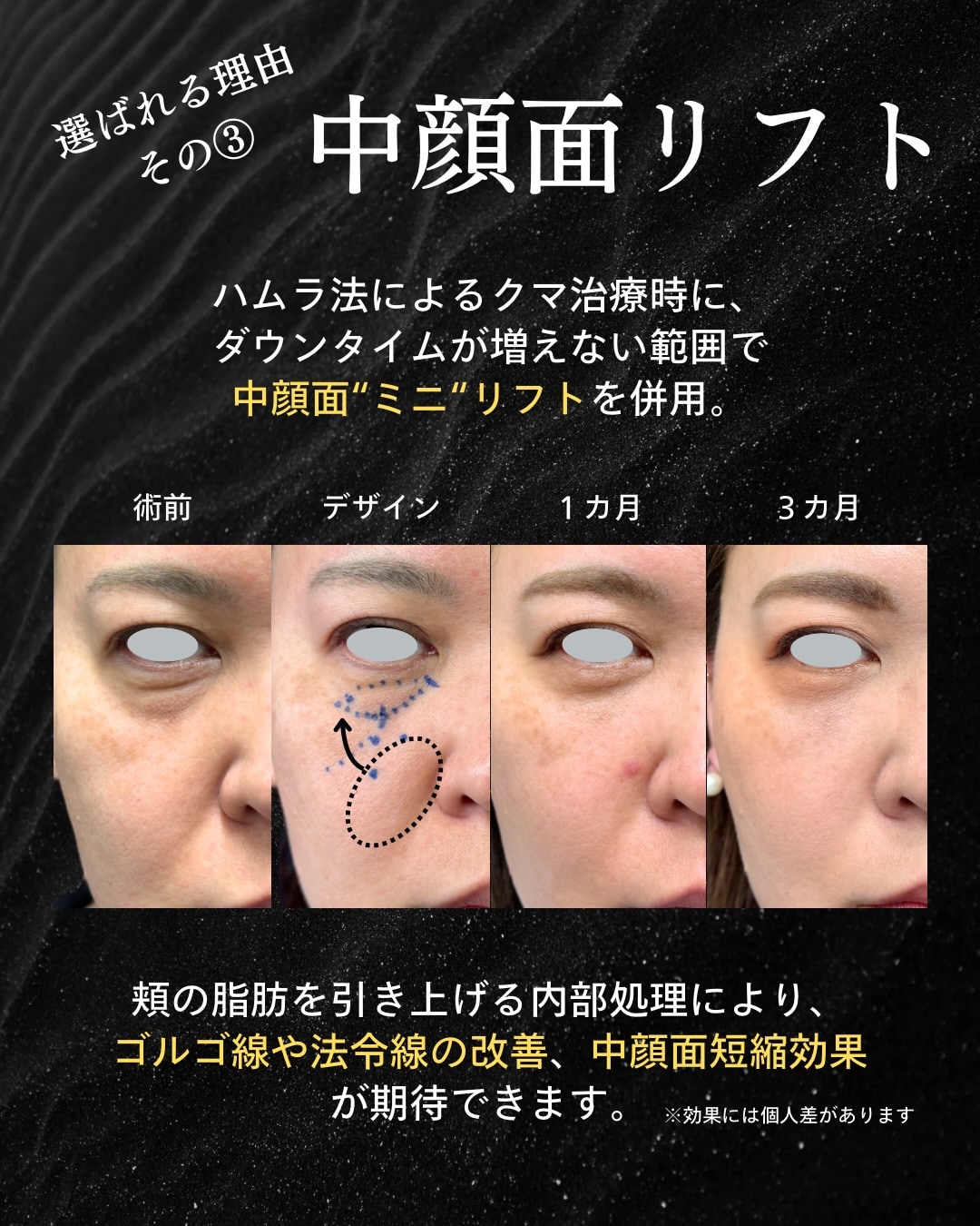 リガメントを剥離