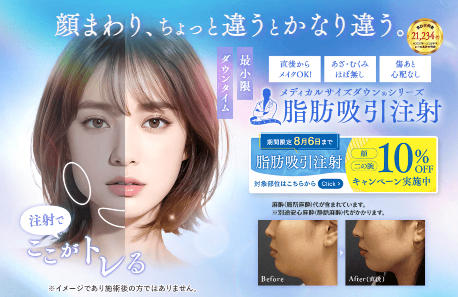 【最小限ダウンタイムで小顔へ】脂肪吸引注射