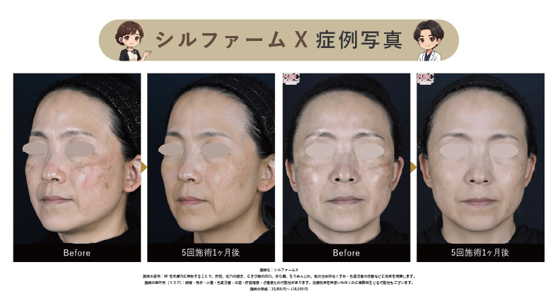 シルファームXの症例写真
