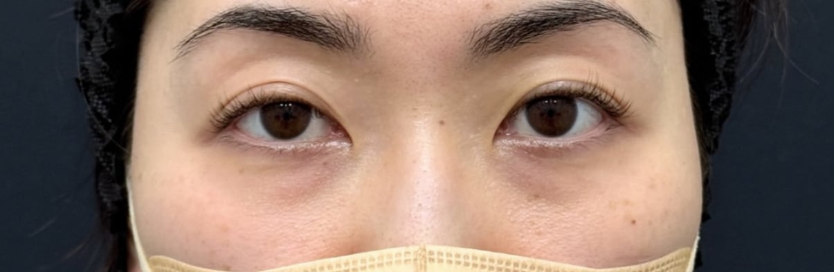 裏ハムラ法（施術前）