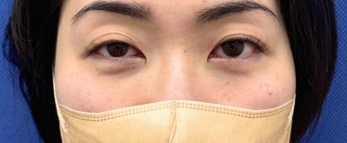 術直後