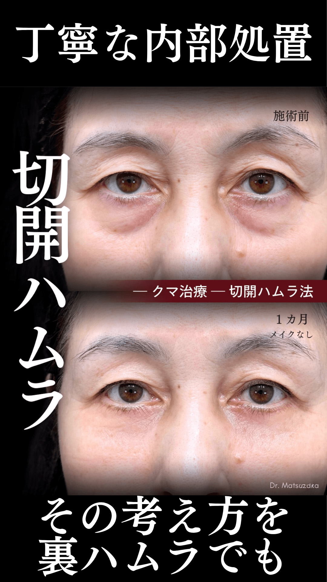 切開ハムラでおこなうような、緻密な内部処理を裏ハムラでも
