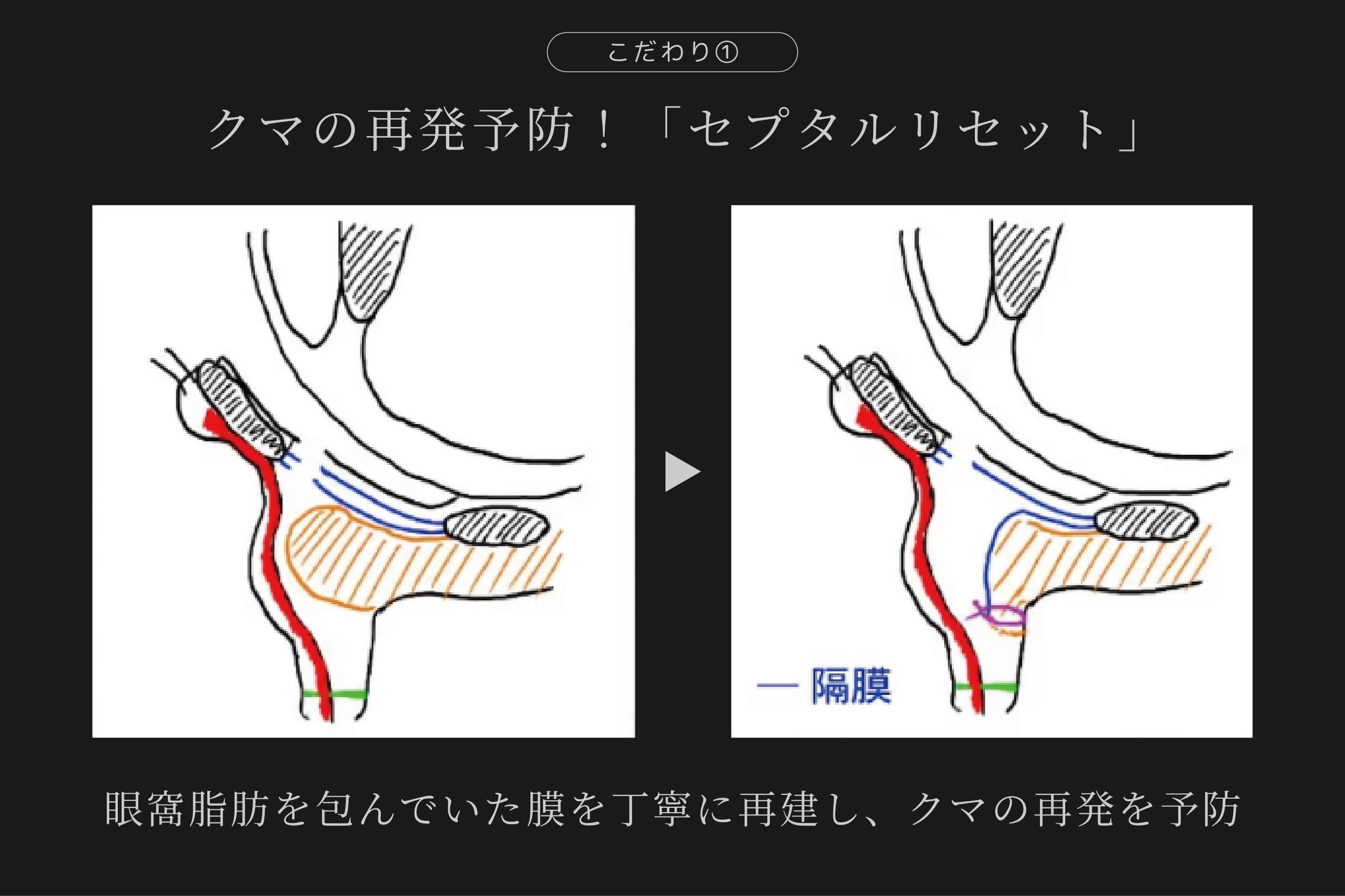 セプタルリセット 1枚目