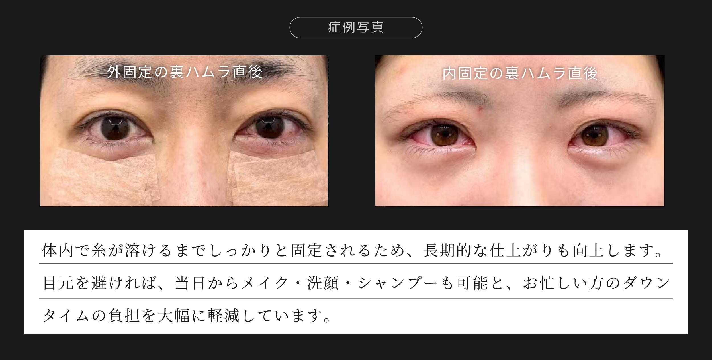 内固定の術式 2枚目
