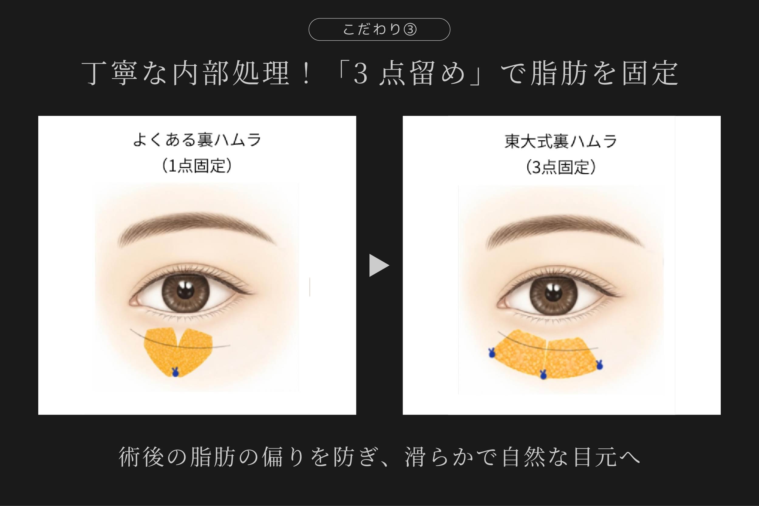 3点留めの技術