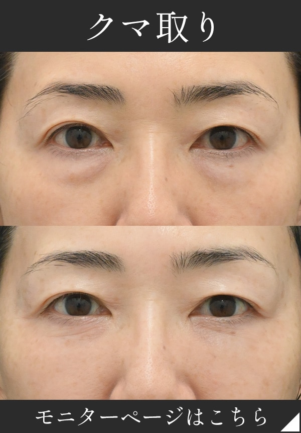 男性にも人気！目の下のくま・たるみ取りで若返り！