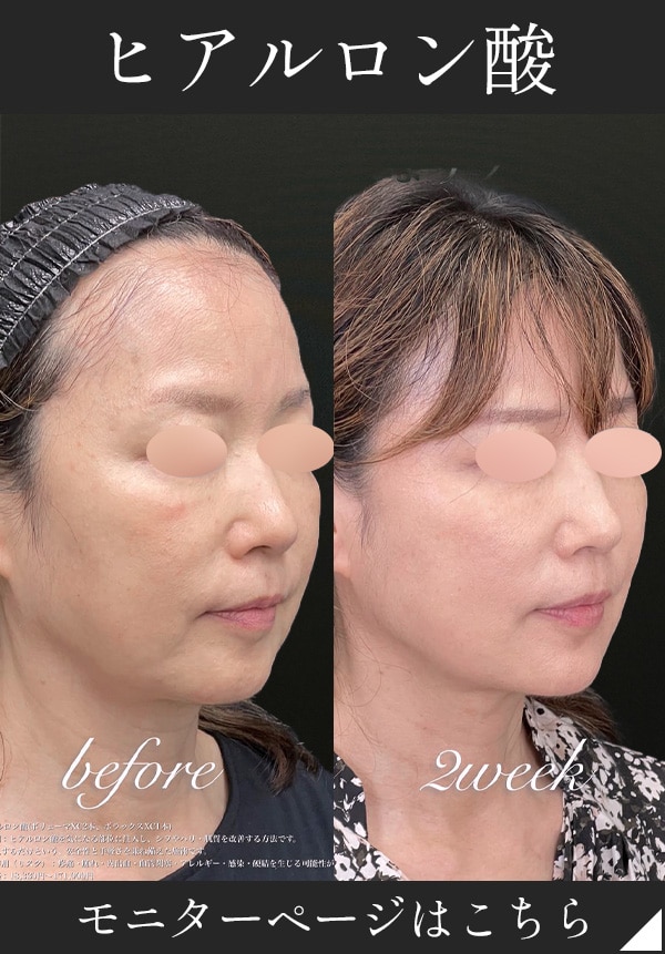 ダウンタイムの少ない切らない若返り術