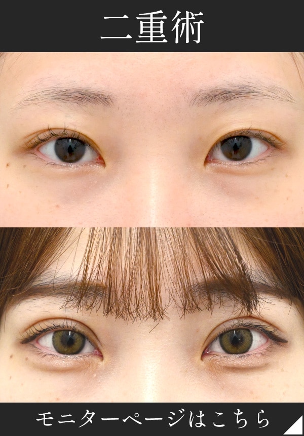 圧倒的なデザイン力で自然な似合わせ二重に！