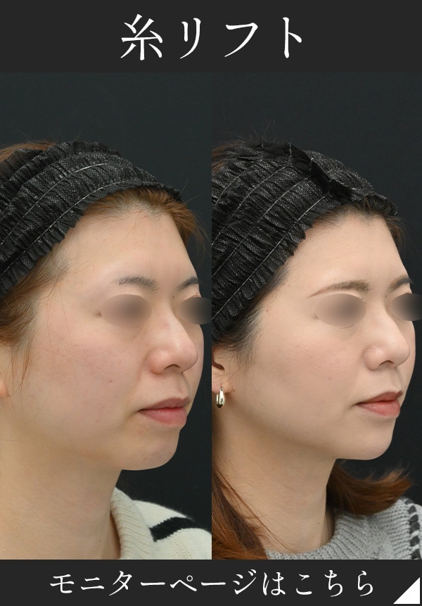 フェイスラインが気になる方はこちら！