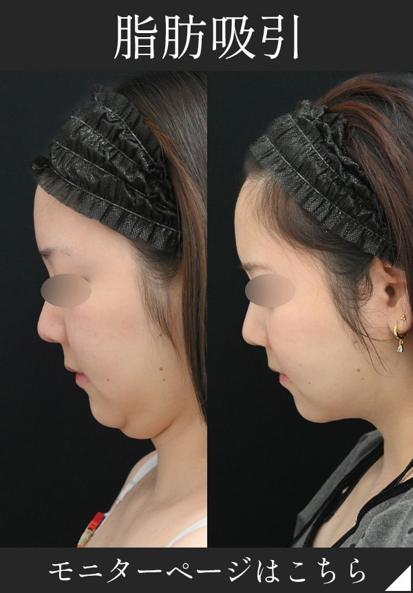 中部症例数NO.1ドクターによる脂肪吸引！