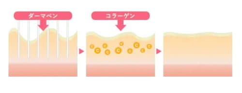 ダーマペンは針で微細な穴を肌に開けます