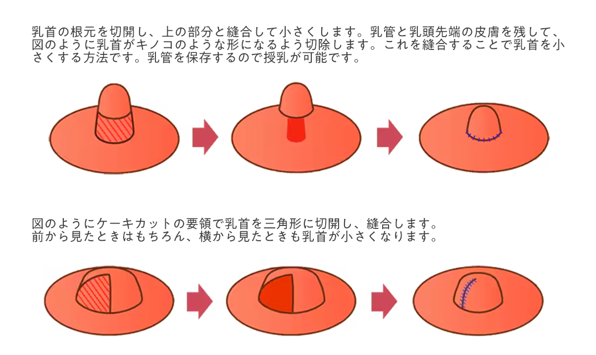 いろいろな乳首　アップ バスト修正】大きくするだけじゃない！乳頭・乳輪・下垂した胸…愛知・東海地方で多様なニーズに応えられる河之口医師のバスト修正術 - 豊田院
