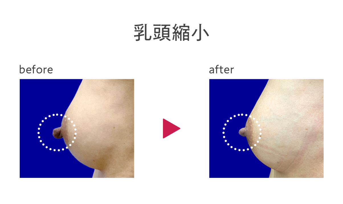 成長中　乳首 バスト修正】大きくするだけじゃない！乳頭・乳輪・下垂した胸…愛知・東海地方で多様なニーズに応えられる河之口医師のバスト修正術 - 豊田院