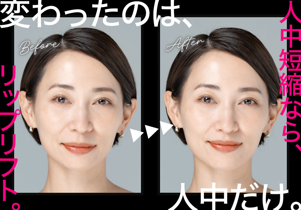 【人中短縮術】愛知・東海地方でリップリフトを受けるなら形成外科専門医のいる湘南美容クリニック豊田院へ