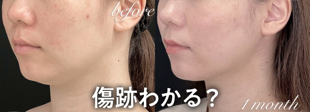 顔の脂肪吸引(1ヶ月目のダウンタイム中)