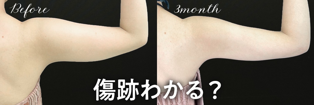 二の腕の脂肪吸引