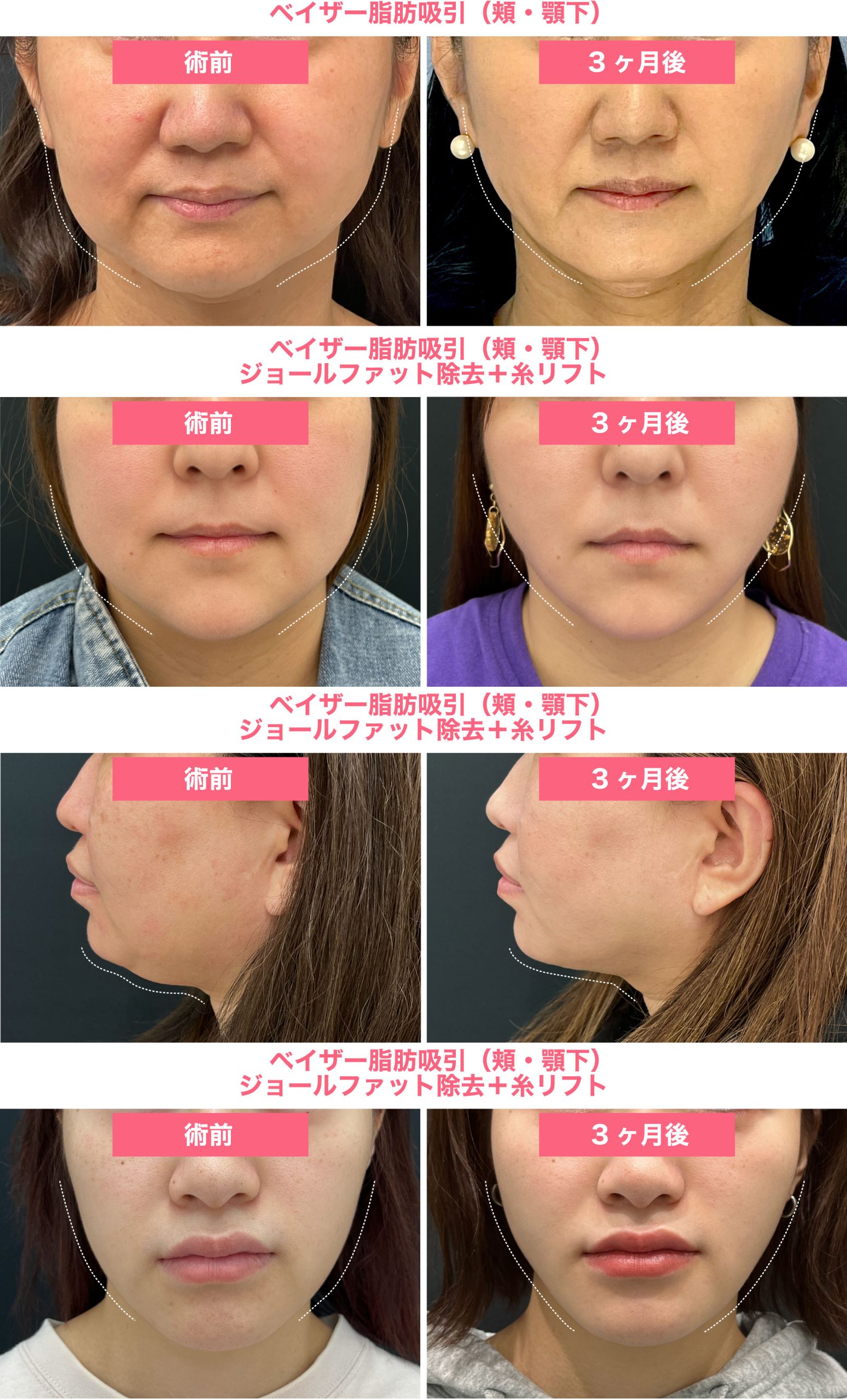 どんな方でも脂肪吸引でスッキリ小顔に！