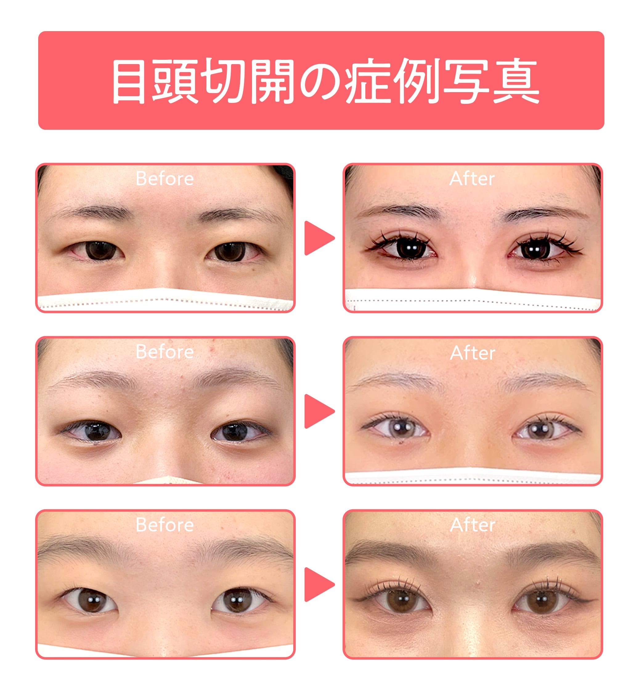 埋没二重術×目頭切開