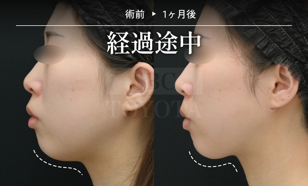 術前|1ヶ月後のBefore/After