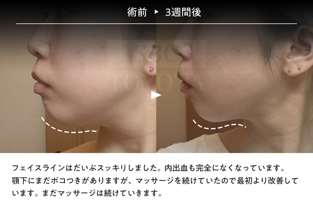 術後3週間目