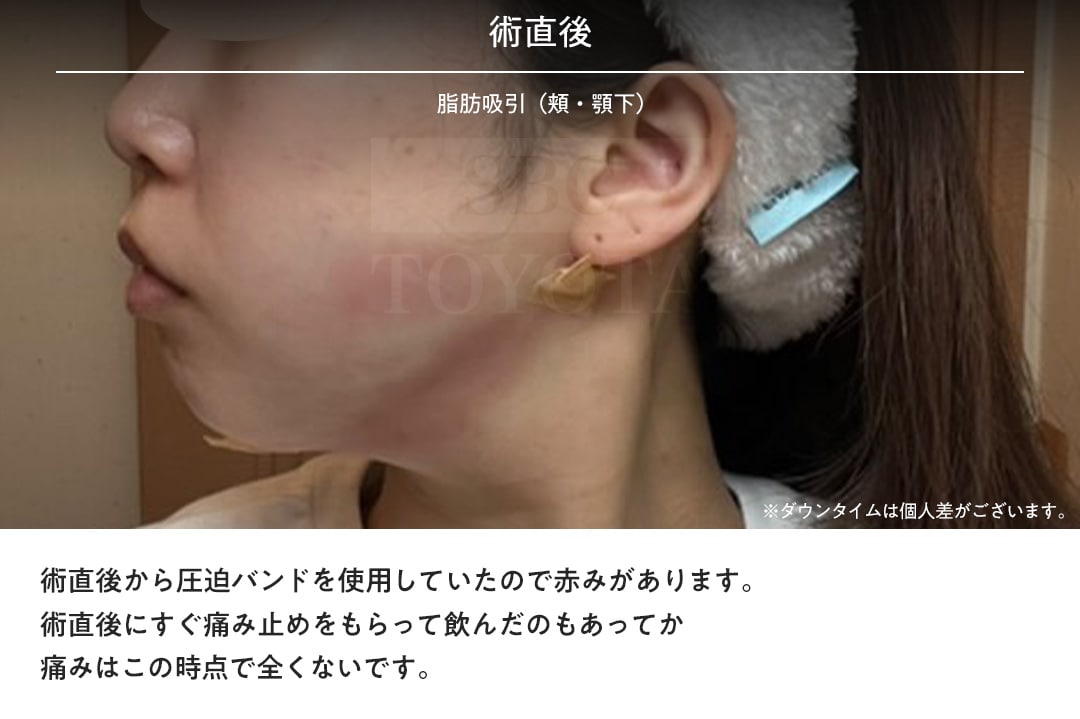 術直後〜3日目