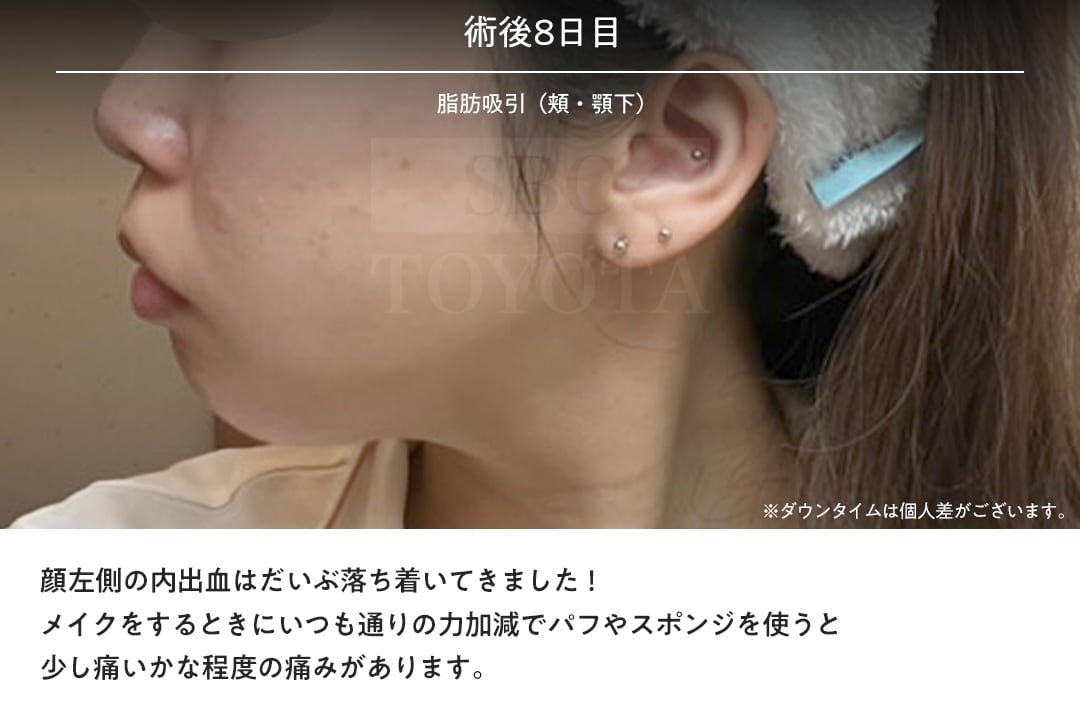 術後8日目〜2週間目