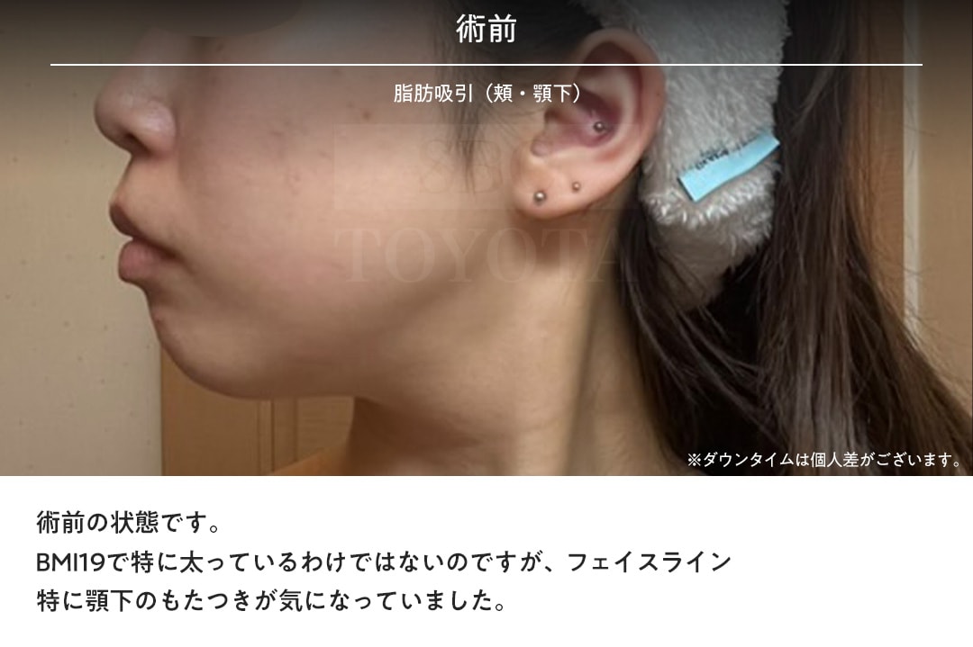 今回のモニター様の術前はこちら