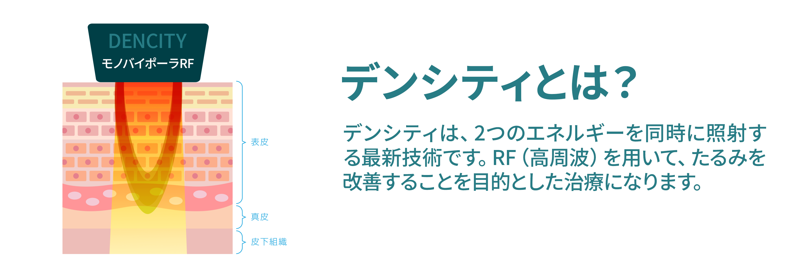 デンシティとは?