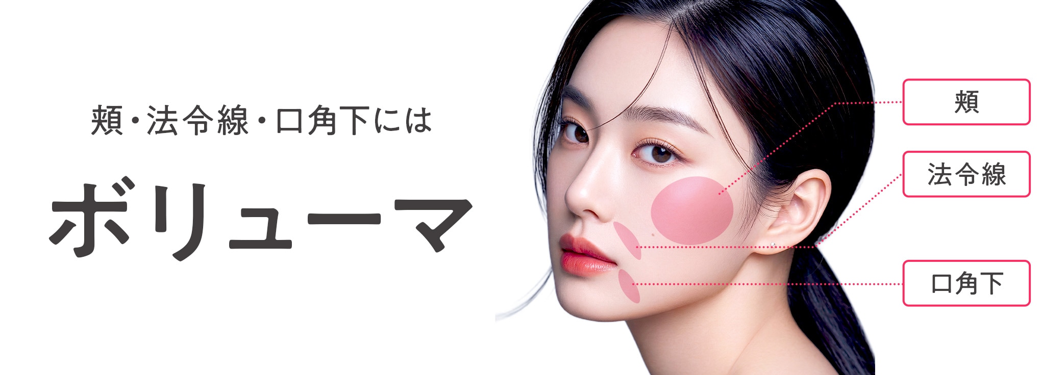 頬・法令線・口角下にはボリューマ