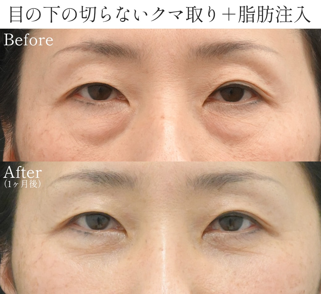 【50代】深刻な下垂・皮膚の余りタイプ