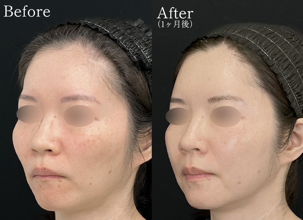 お顔全体にハリを取り戻す全顔脂肪注入