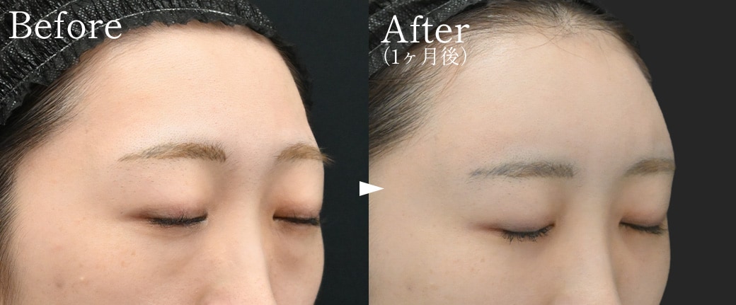 まんまるおでこの輪郭形成