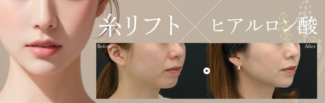 糸リフト×ヒアルロン酸注入