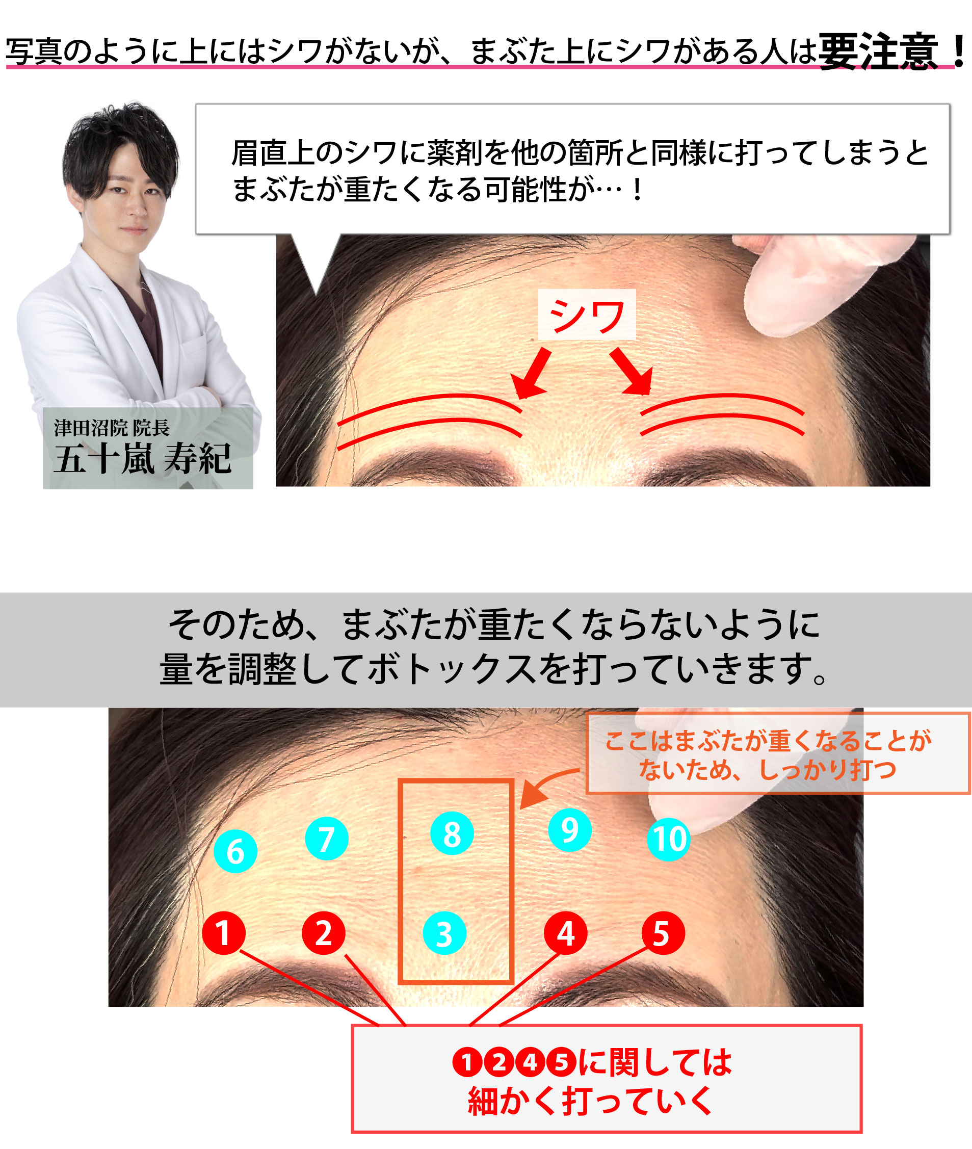 まぶた上の注入量は人によって変える！
