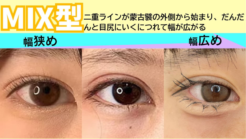【MIX型】末広型と平行型の良さを兼ね揃えたデザイン