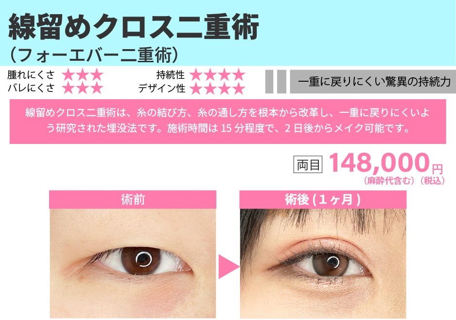 持続性を重視したい方におすすめの埋没法