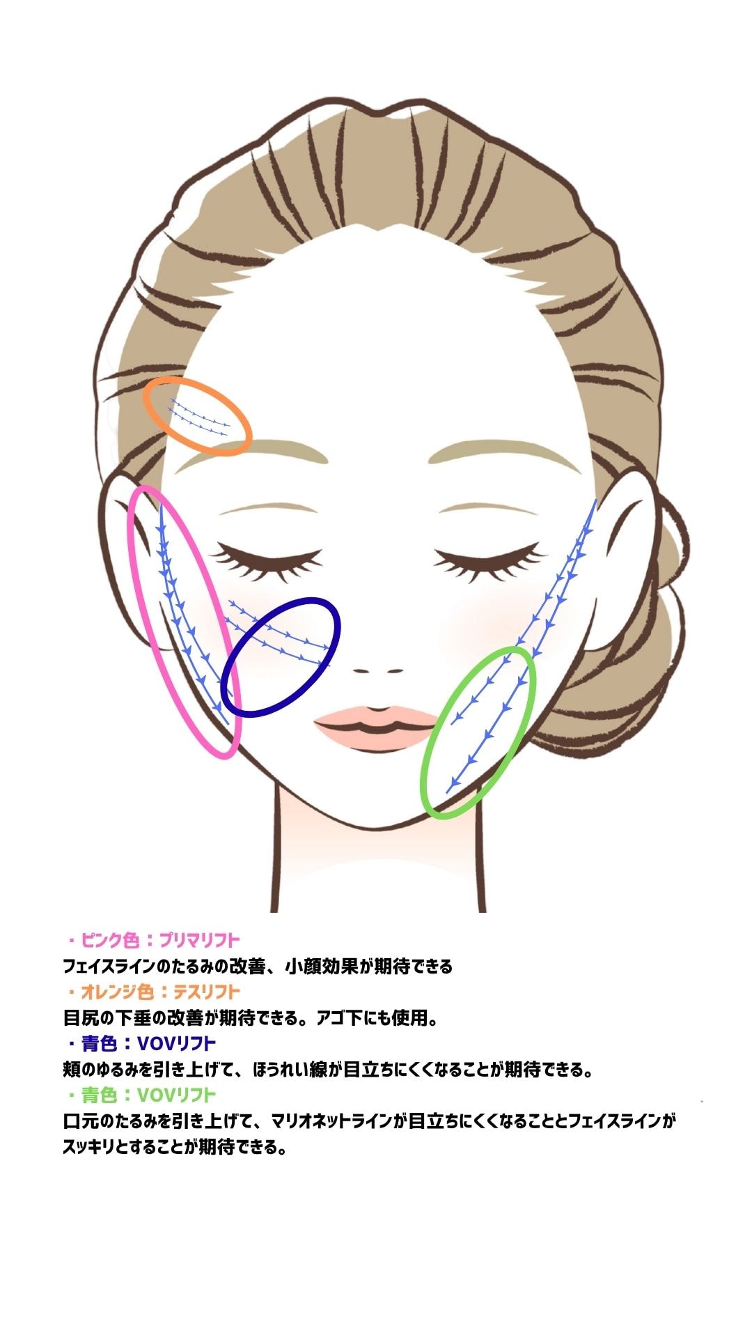 糸リフト適応部位図