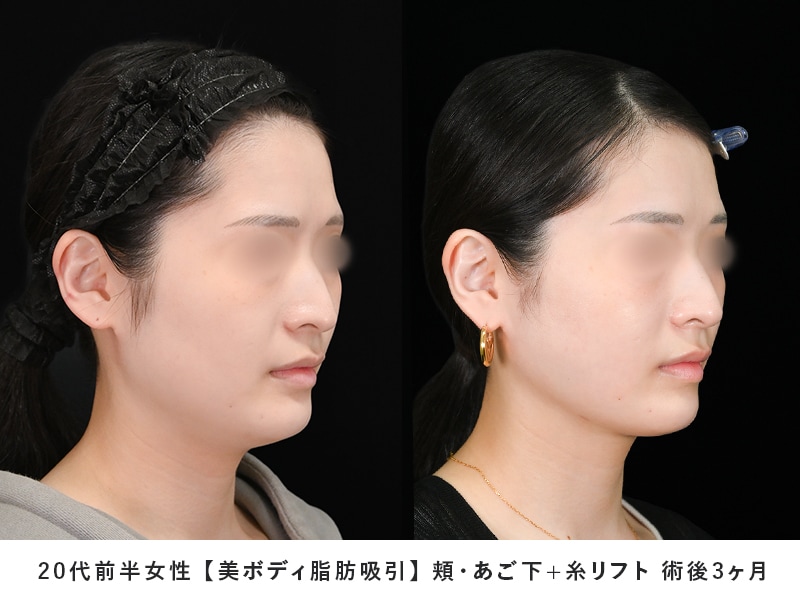 顔の脂肪吸引症例1