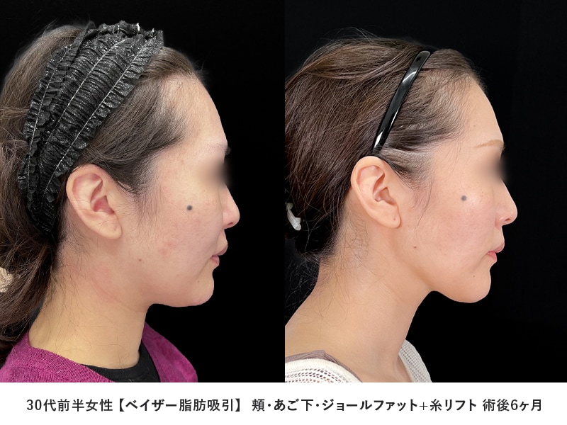 顔の脂肪吸引症例2